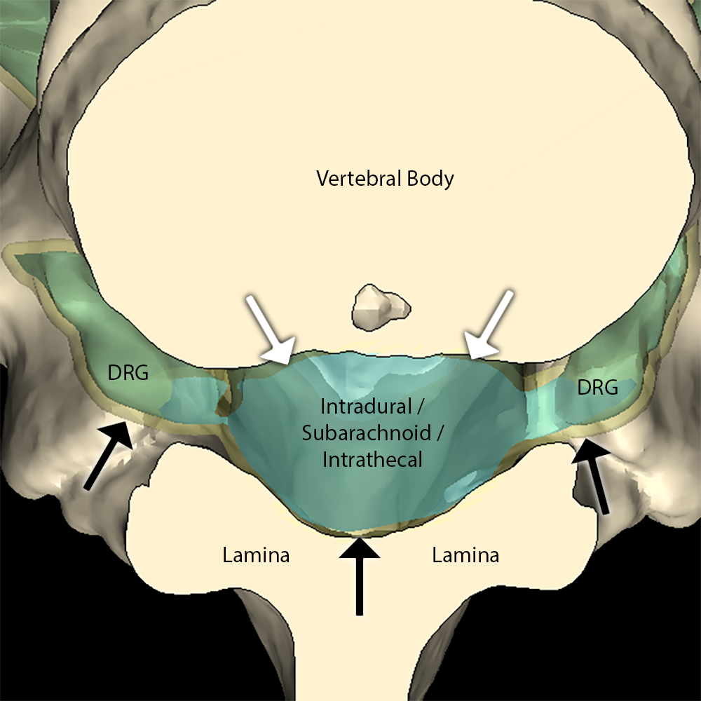 Note the yellow epidural fat (black arrows) surrounding the meninges (white arrows) and extending along the nerve roots. DRG = dorsal root ganglion. 