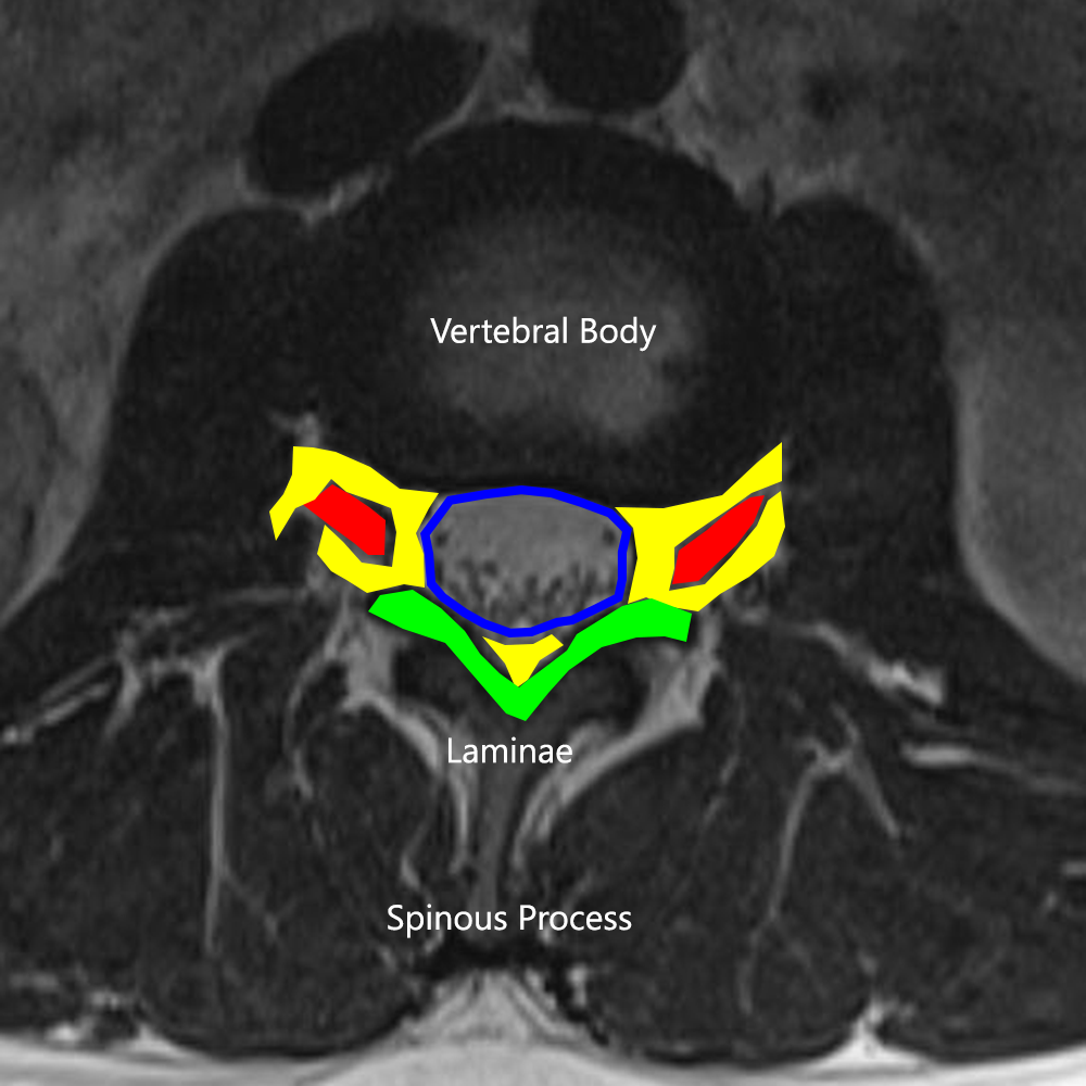 Yellow = Epidural fat; blue = dura/arachnoid; red = exiting nerve with dorsal root ganglion; green = ligamentum flavum