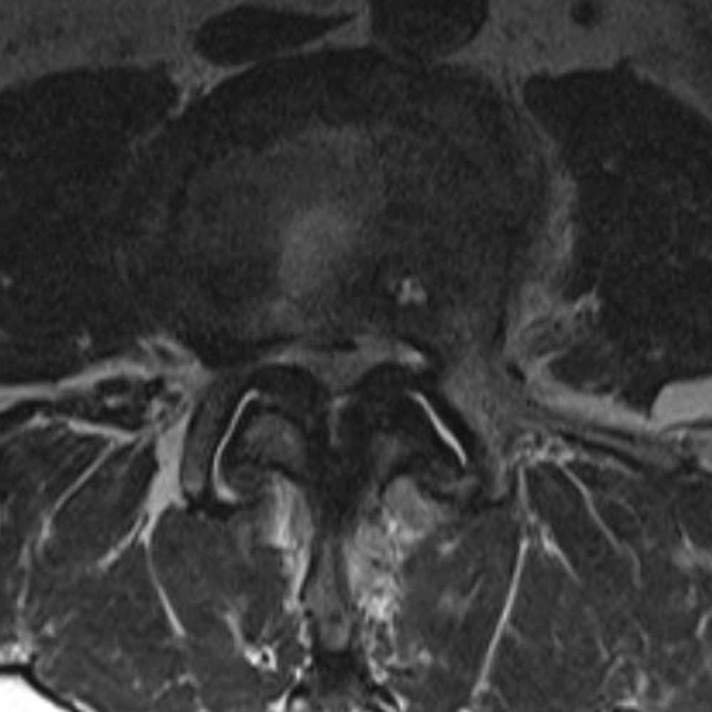 Note how severe ligamentum thickening obliterates the dorsal epidural fat in this case.