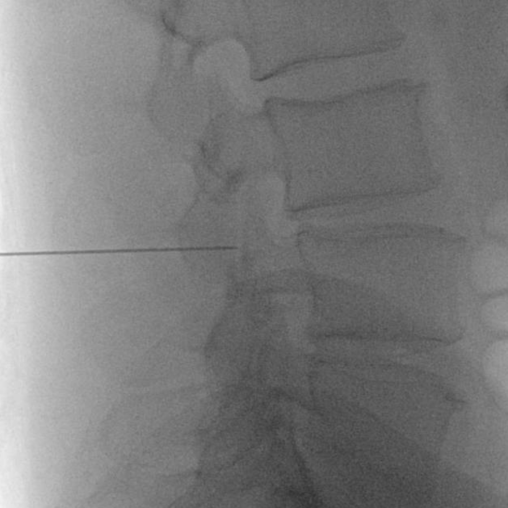 Cross table laterals are very helpful for determining needle depth. On this image, the needle is just short of the spinal canal, and advancing the needle a few mm should do it. 