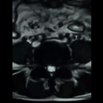 This is an MRI done while the patient valsalvas. The increased size of the epidural veins and associated mass effect on the spinal canal is remarkable. It is easy to appreciate why valsalva raises CSF pressure. (Case courtesy Andrew Plumb)

