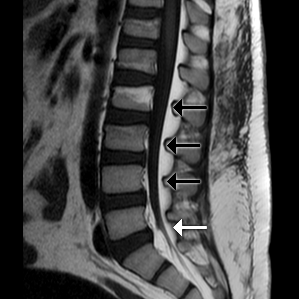 This was a young obese patient who had an unsuccessful LP attempt at multiple levels. MRI reveals abundant epidural fat effacing CSF at multiple levels (black arrows) and a thecal sac that terminates just about L5-S1 (white arrow).
